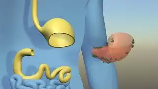 Subtotal Gastrectomy (for patients)