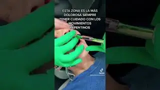 ANESTESIA DENTAL EN NIÑOS
