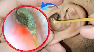 Deep Ear Wax Removal ASMR 👂 | Hidden Infected Ear Cleaned After Months! | Ep166