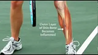 Do You Suffer From Shin Splints?
