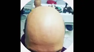 Protesi Capelli Veri