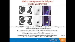 PET CT for RT Planning include Respiratory Gating