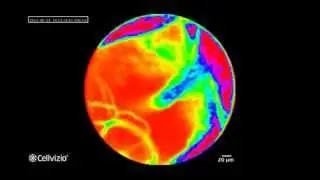Blood Brain Barrier breakdown follow-up in real time for drug delivery