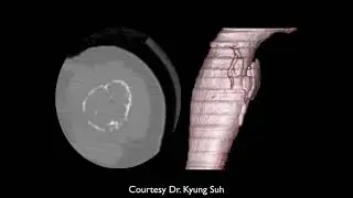 Bone Tumors Pt 2