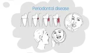 Diabetes Dental Care Animated Video