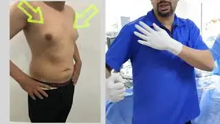 علاج التثدي - من الدرجة الثانيه