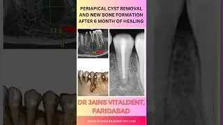 Oral Cyst removal and it's healing-Dr Vishal Jain #faridabaddentist #dentistry