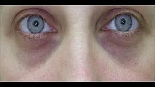 Dark Circle Removal in Andheri, Mumbai, India- Alluremedspa
