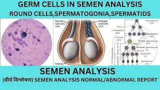 GERM CELL IN THE SEMEN.SPERMATOGONIA,SPERMATIDS IN SEMEN.CAUSES OF IMMATURE CELLS IN SEMEN