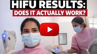 ​I Got HIFU at Work! | Non-Surgical Face Lift Results ||Heart'svlogs||