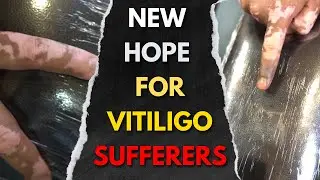 Stop Vitiligo Progression! Best Treatment Methods to Try This | Machu Tattoos | Hyderabad | Chennai