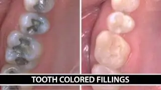 Tooth-colored Dental Fillings San Jose, CA -- Dr. Robert Barr