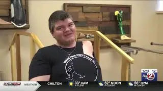 Shoulder Disarticulation amputation prosthesis