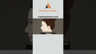 Cheekbone Reduction | Answer Plastic Surgery #shorts #cheekbonereduction