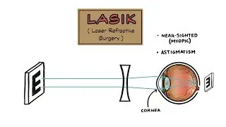 LASIK (Laser Eye Surgery)