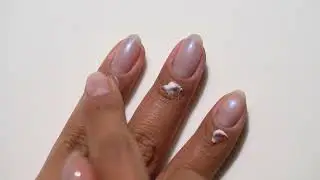 Dermelect Nail Recovery System