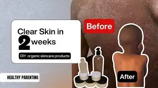 These 3 DIY Products Saved My Son's Sensitive Skin!