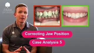 Case Analysis 5: Correcting Jaw Position with Invisalign MA