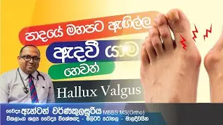 පාදයේ මහපට ඇඟිල්ල ඇදවීම, Hallux valgus deformity