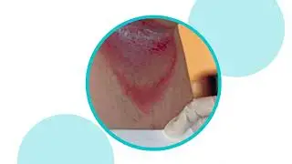 Instructions for Use Coloplast InterDry Skin Fold Management