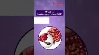 Pseudomyxoma Peritonei | Early Diagnosis & Surgery | Dr. Deepika Gupta