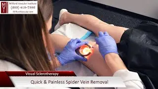 Spider Vein Treatment Using Sclerotherapy New Haven CT
