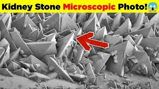 Kidney Stone Microscopic Photos || AIO Mystery #short