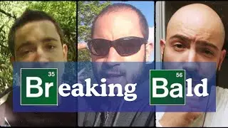 My Hair Loss Story - Accepting Baldness
