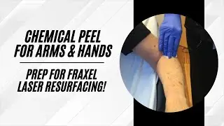 Chemical Peel on Arms and Hands | Prepping the Skin for Fraxel Laser Resurfacing | Live