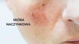 Skóra naczynkowa. Jak zmniejszyć uciążliwy rumień?