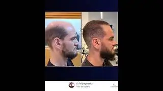 Norwood 7 !!! Amazingly result  .. Hair transplant _ Dr.Felipe Pittella #hairtransplant
