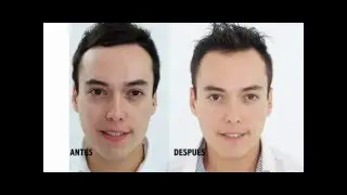 Tratamiento Anti Ojeras