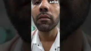 White Beard Removal Treatment By Fue Method | White Beard Permanent Solution | #whitebeard #fue