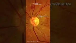 Proliferative Diabetic Retinopathy | #Shorts