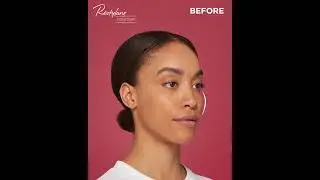 Restylane Contour Morphing Before and Afters- Maya
