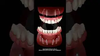 Dental Implant Full Arch / All on X ( All on 4, All in 5, All on 6, Pro-Arch, Neo-Arch, TeethXpress)