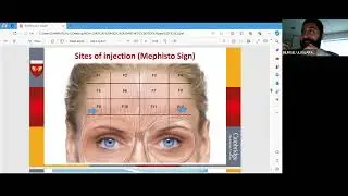 دبلوم التجميل الطبي الغير جراحي  / BOTOX /   محاضرة 3