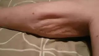 Severe leg cramp