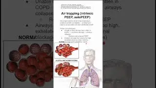 Air trapping (intrinsic PEEP, autoPEEP)