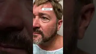 Hooded Eyelids & Eye Bag Treatment For Men | Quadfecta Lift with Dr. Kami Parsa