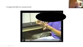 Congenital Mirror Movements