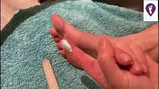 How to look after foot callus (Filing and creaming)