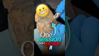 Why Laser Tattoo Removal Takes So Much Time - Faded Podcast