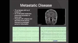Webinar - What you need to know if you have a brain tumor and epilepsy - Jeffrey Politsky, MD