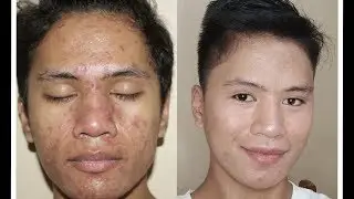 Acne Journey | Severe Acne| Part 1
