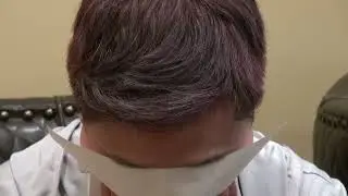 Complete Hair Restoration Treatment by Los Gatos Hair Transplant