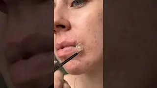 another day another pimple patch video 🫶🏻