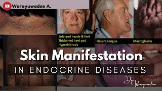 Skin signs in Endocrine diseases