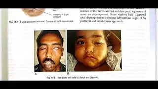 Facial nerve disorders