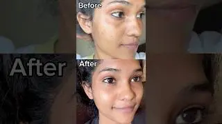 Results in 1 week😱amazing product😍#glowskin#skincare #clearskin